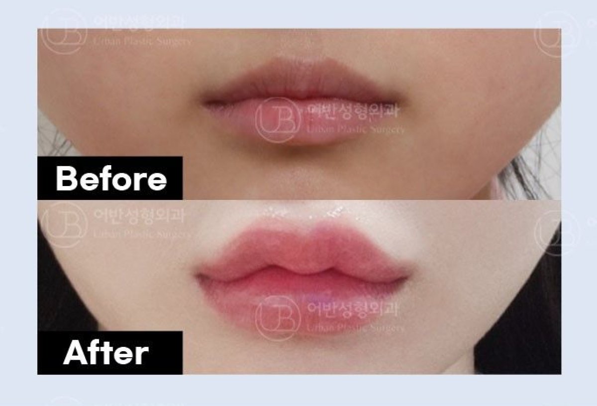 Resultados de lifting de labios antes y después en URBAN Plastic Surgery – forma mejorada