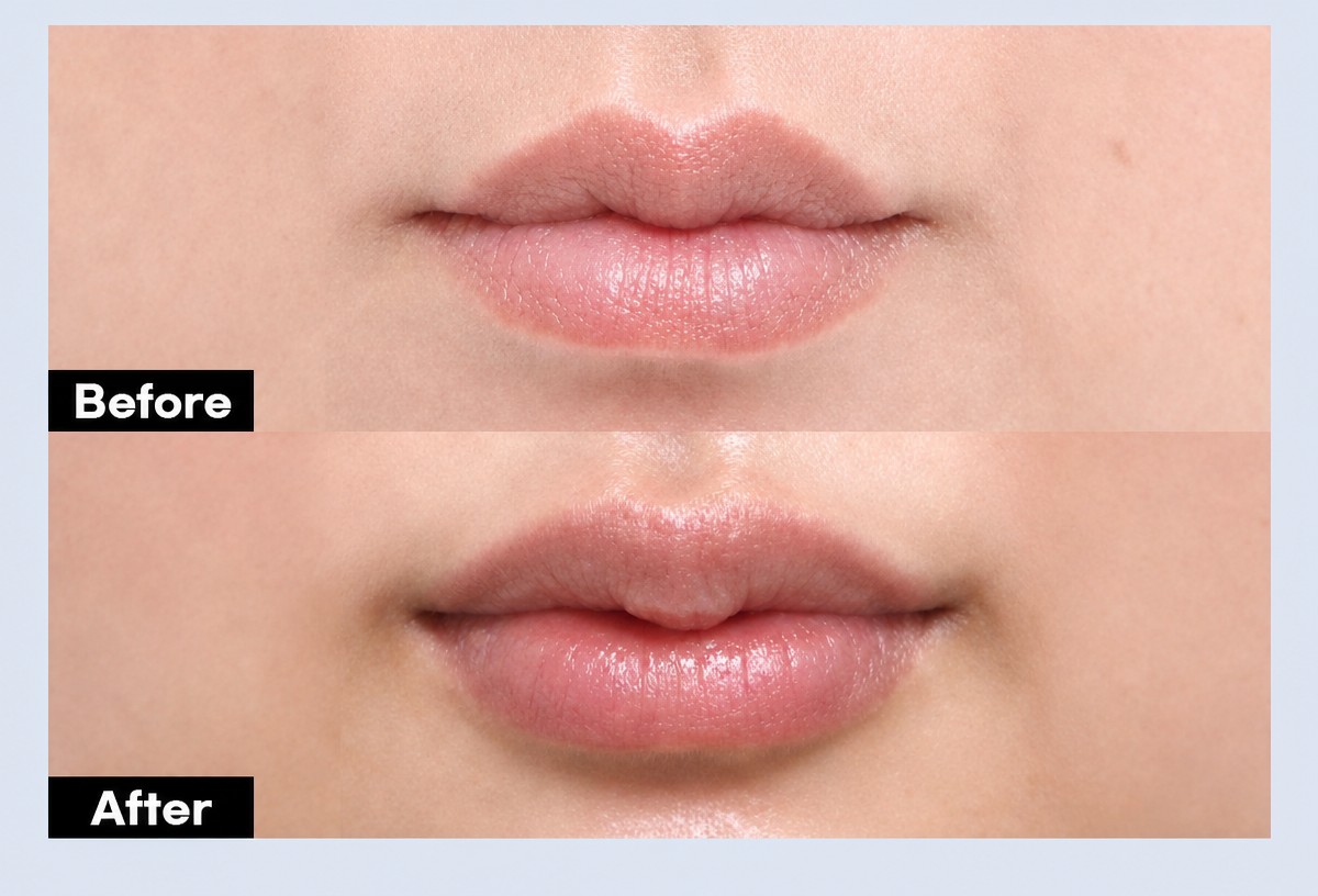 Before and after lip lift results at URBAN Plastic Surgery, enhanced upper lip contour