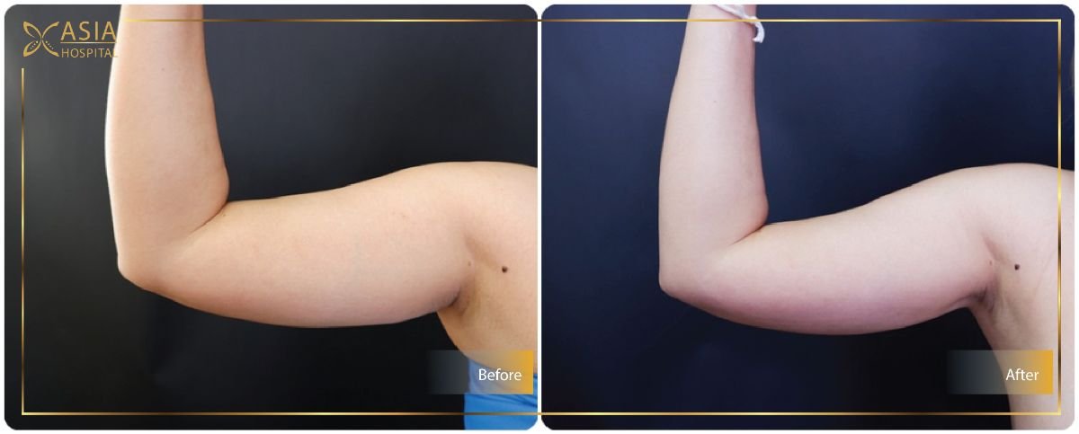 Résultats avant et après liposuccion Vaser des bras à Asia Cosmetic Hospital