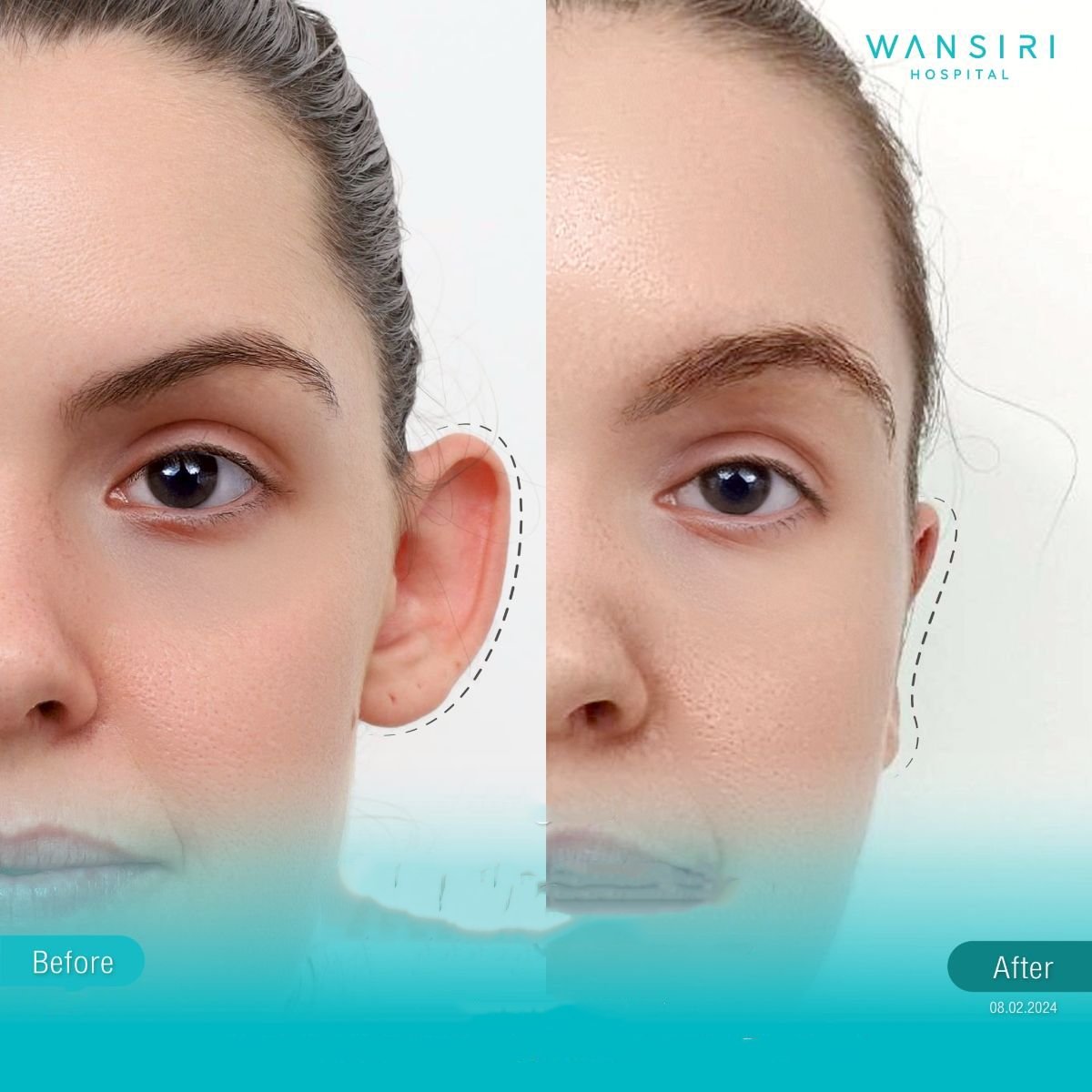 Before and after otoplasty results at Wansiri Hospital, ear reshaping with natural appearance