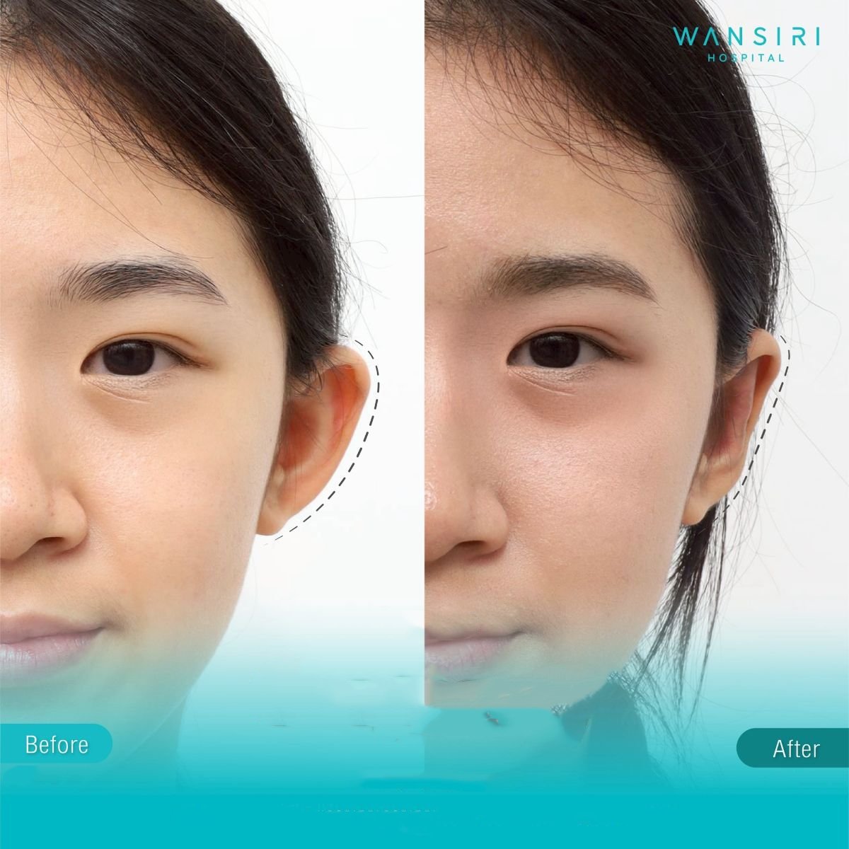Before and after otoplasty results at Wansiri Hospital, ear reshaping surgery improvement