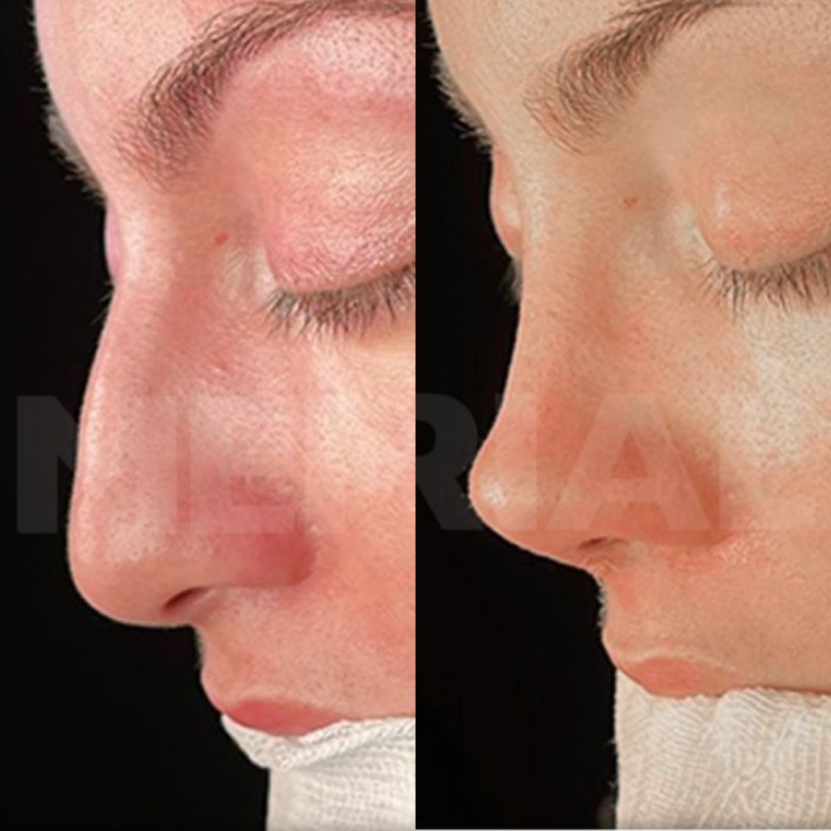 Résultat avant/après rhinoplastie ultrasonique à Memorial Bahçelievler Hospital, remodelage du nez