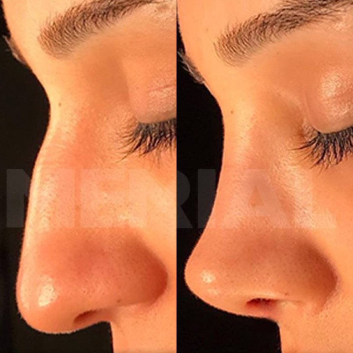 Resultados antes y después de rinoplastia ultrasónica en Memorial Bahçelievler Hospital, remodelación nasal