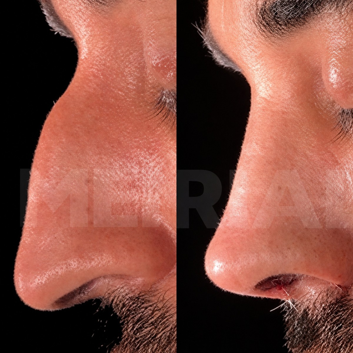 Before and after ultrasonic rhinoplasty results at Memorial Bahçelievler Hospital, nose reshaping