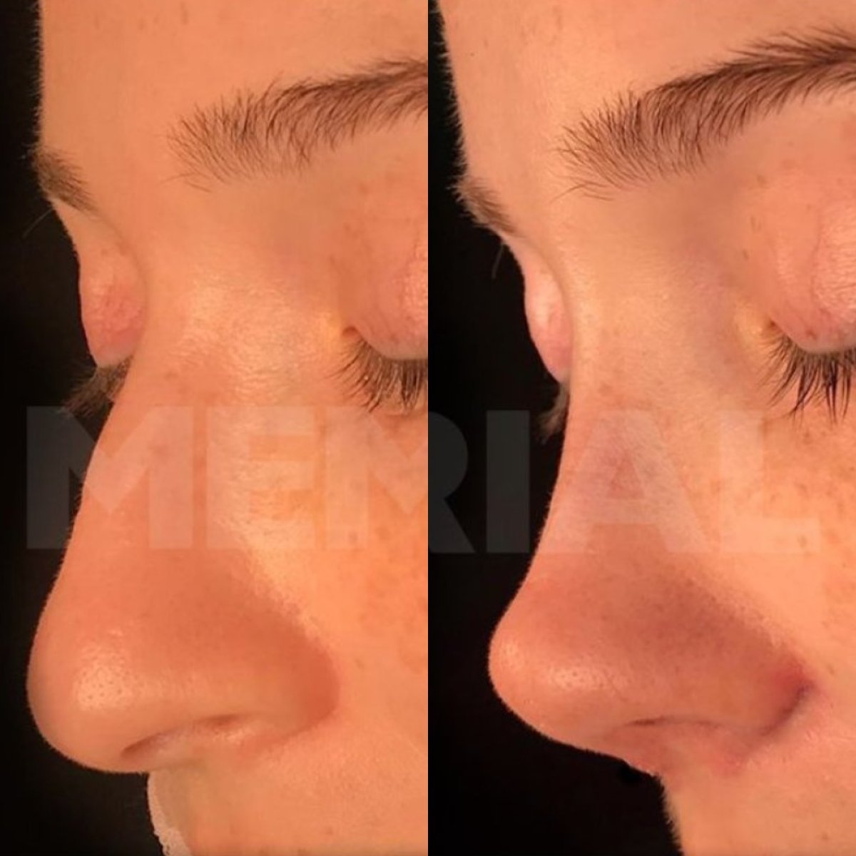 Resultados antes y después de rinoplastia ultrasónica en Memorial Bahçelievler Hospital