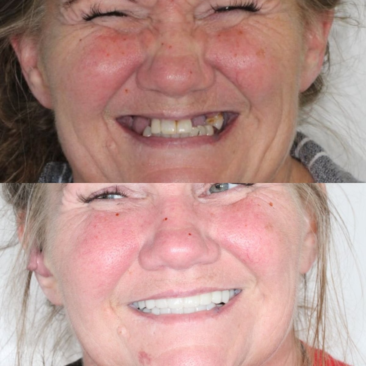 Resultados antes y después de dentadura postiza en Ivan Implant and Cosmetic Dental – sonrisa restaurada