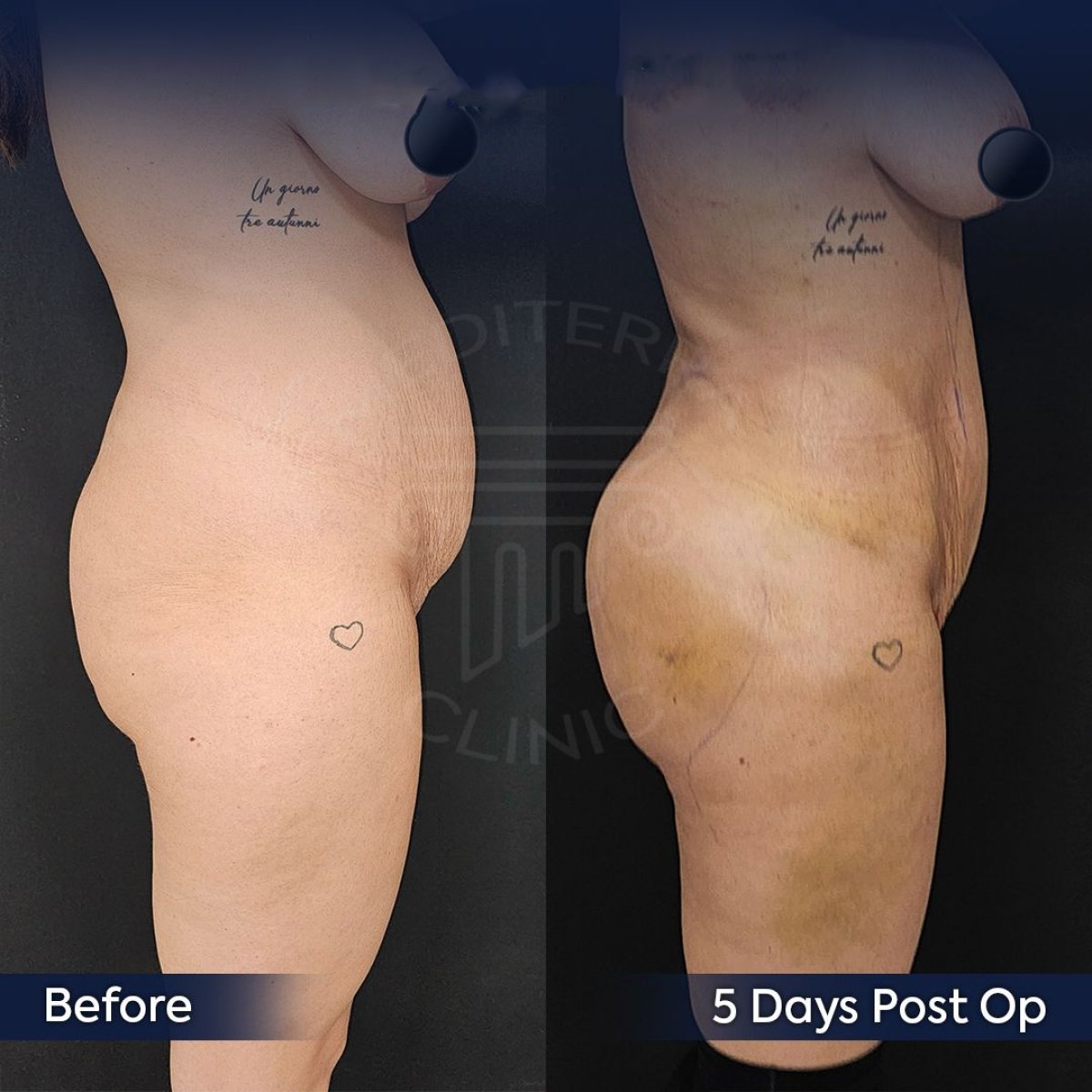Résultats avant/après Brazilian Butt Lift à la clinique Dr. Safa Manav, silhouette affinée