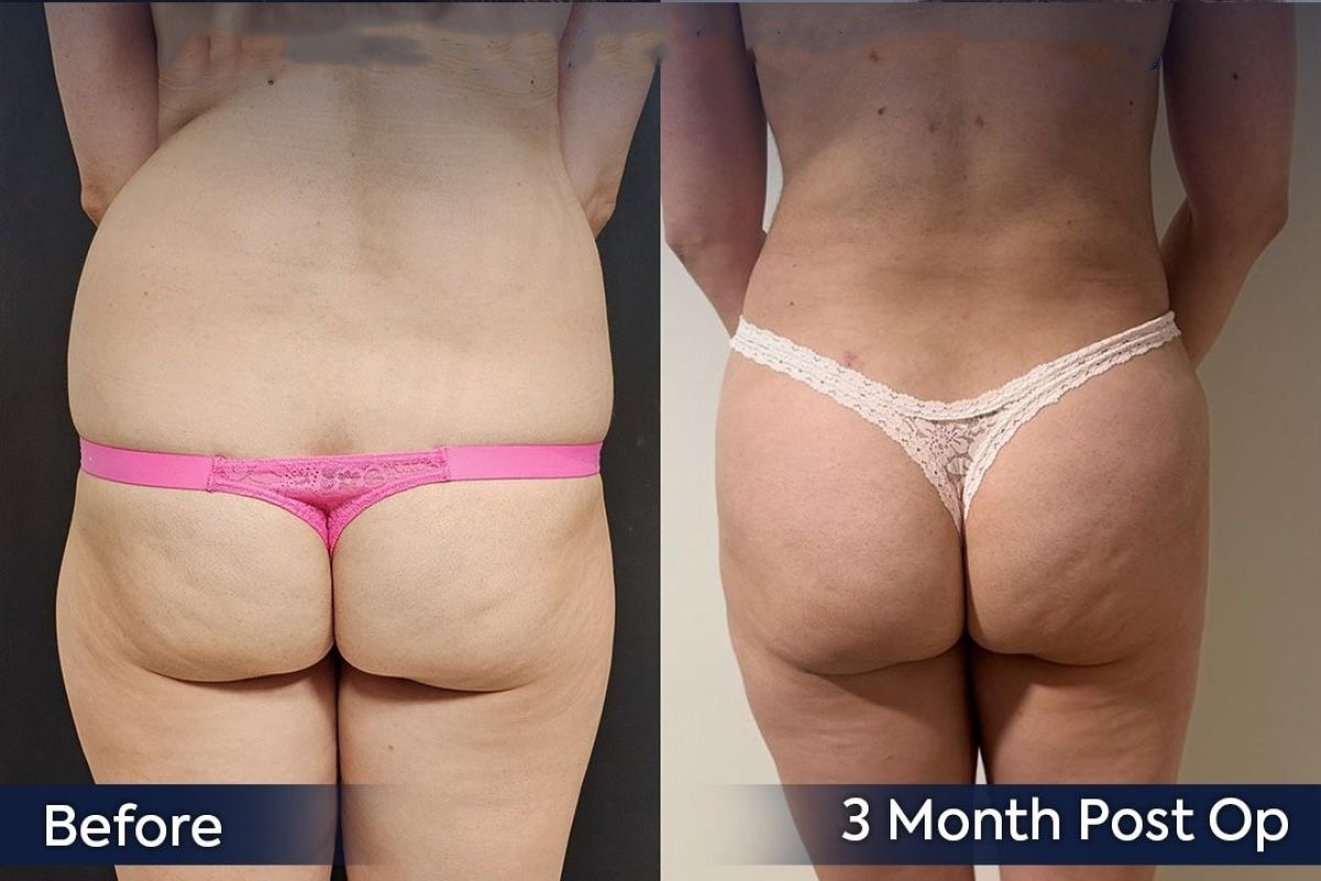 Brazilian Butt Lift before and after results at Dr. Safa Manav Clinic, 3 months post-op
