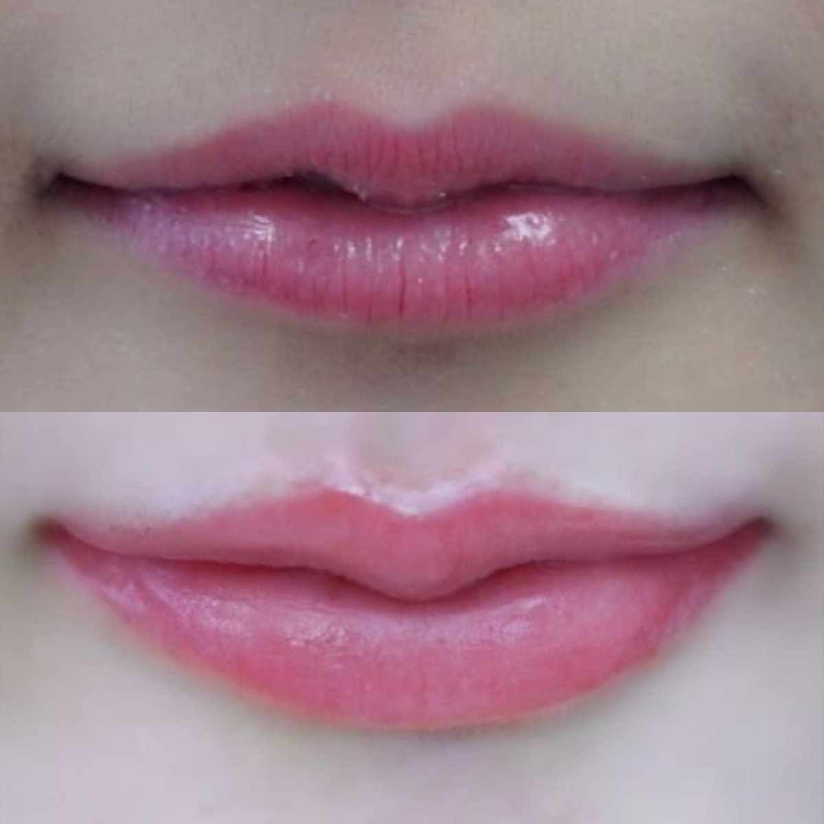 Before and after lip lift results at Asia Cosmetic Hospital, enhanced lip contour and shape