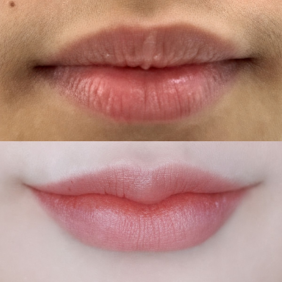 Before and after lip lift results at Asia Cosmetic Hospital, enhanced lip shape and contour