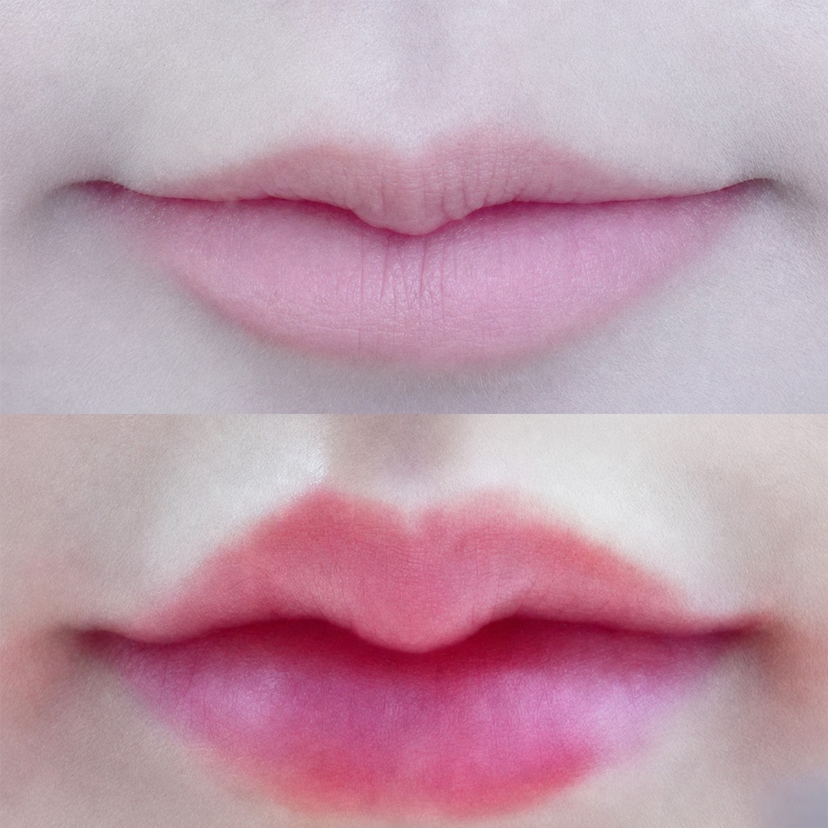 Before and after lip lift results at Asia Cosmetic Hospital, enhanced lip contour and volume