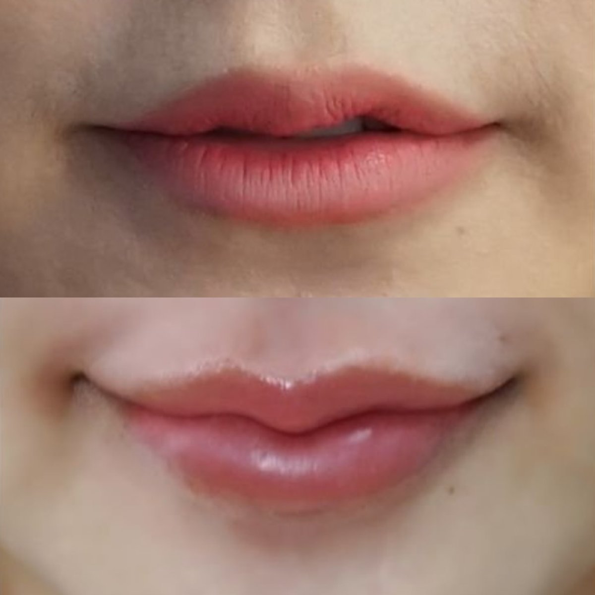 Before and after lip lift results at Asia Cosmetic Hospital, enhanced lip shape and contour