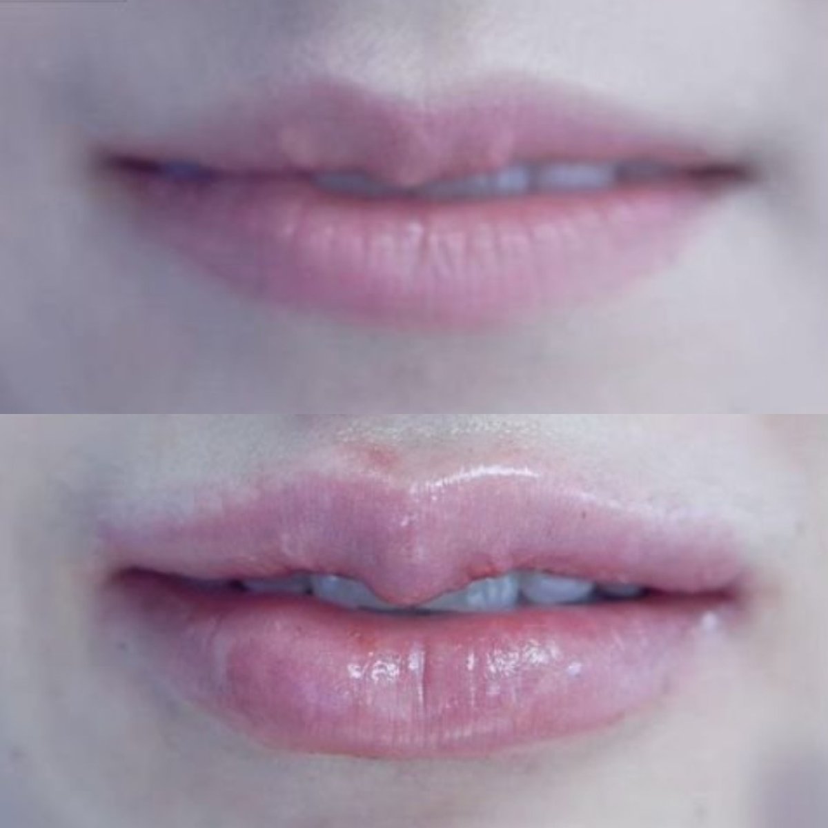 Before and after lip lift results at Asia Cosmetic Hospital, enhanced lip contour and volume