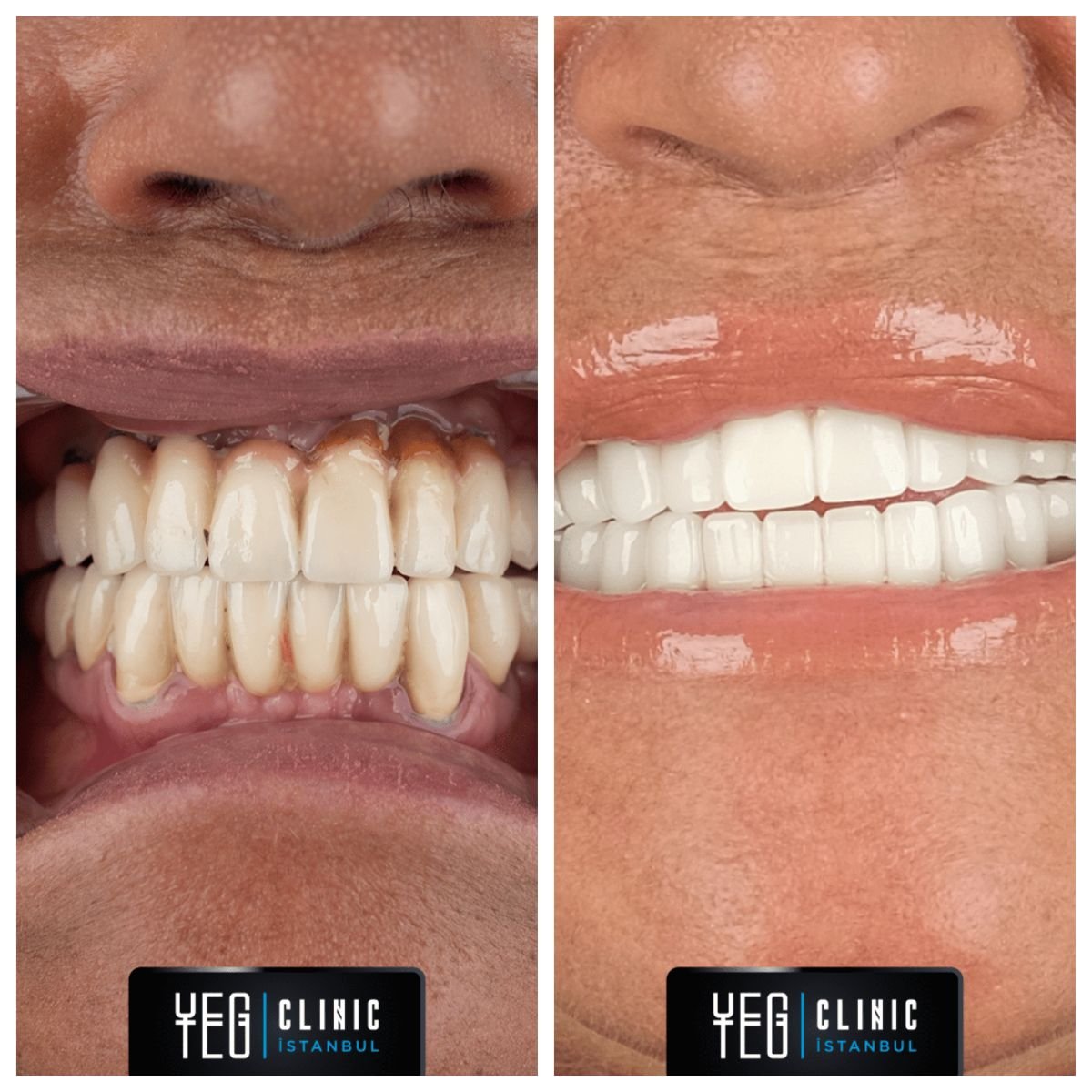 Antes y después de la instalación de dentaduras completas en YEG Clinic, mejora estética dental
