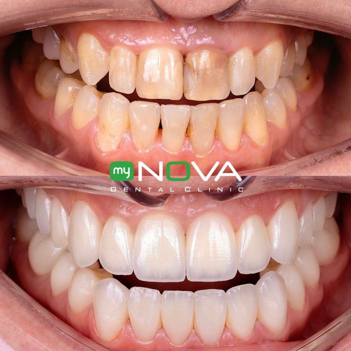 Resultados antes y después de coronas de zirconia en My Nova Kusadasi Dental Clinic, sonrisa renovada
