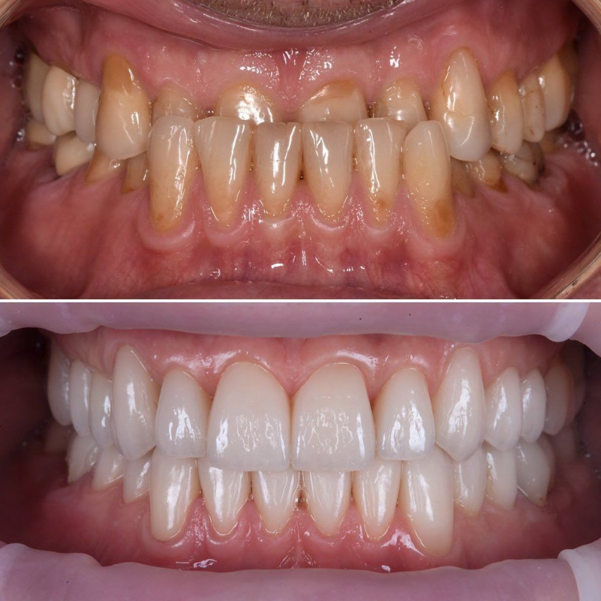Результати до і після встановлення цирконієвих коронок у My Nova Kusadasi Dental Clinic