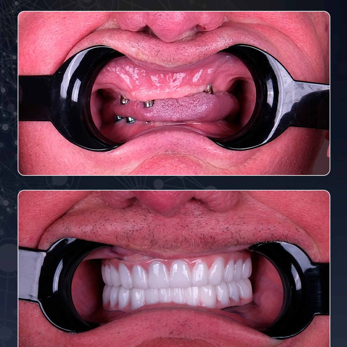 Before and after All-on-6 dental implants result at Lara Smile Dental Clinic, full smile restoration