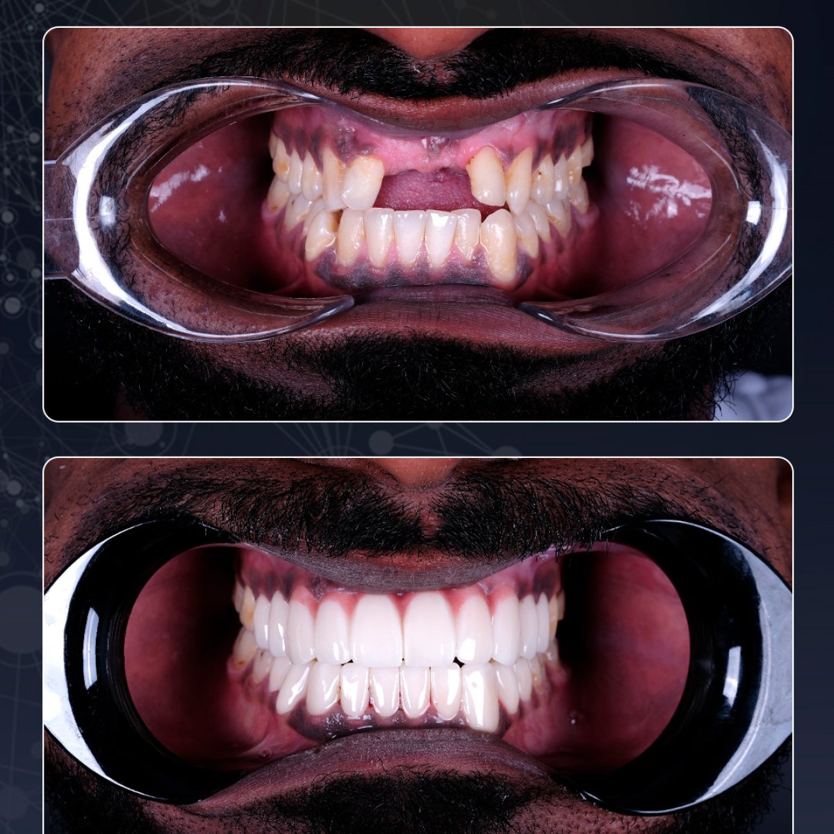 Before and after zirconia crown results at Lara Smile Dental Clinic – smile makeover