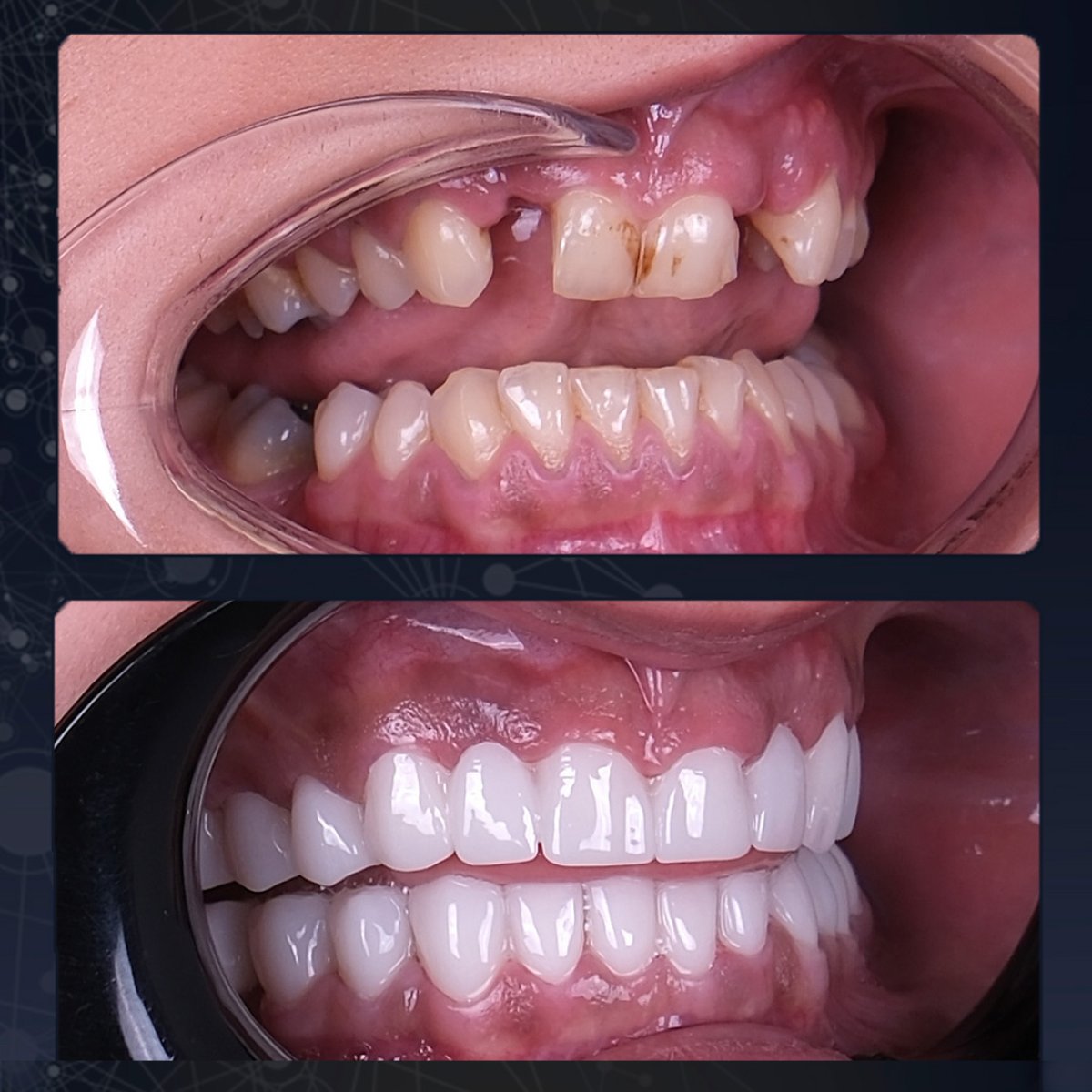 Before and after zirconia crown results at Lara Smile Dental Clinic – smile restoration