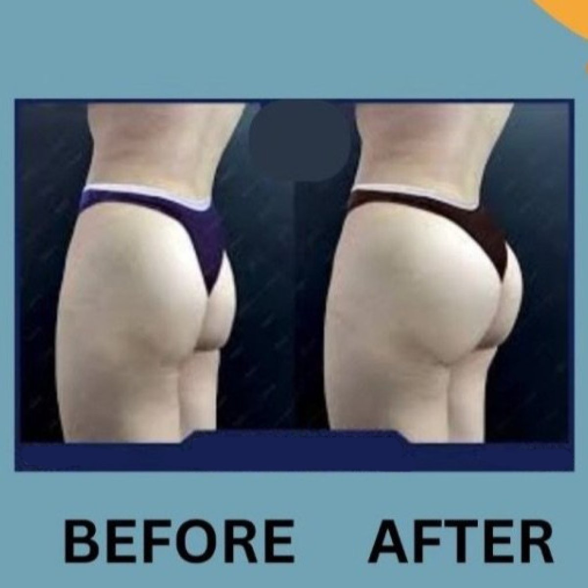 Before and after buttock lift results at ID Clinic Bangkok, improved contour and lift