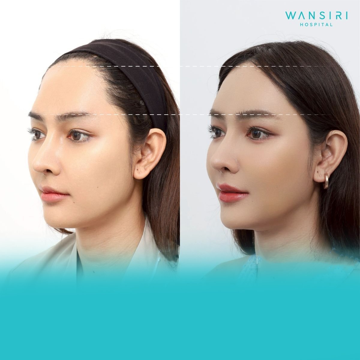 Antes y después de transferencia de grasa facial en Wansiri Hospital, contorno mejorado