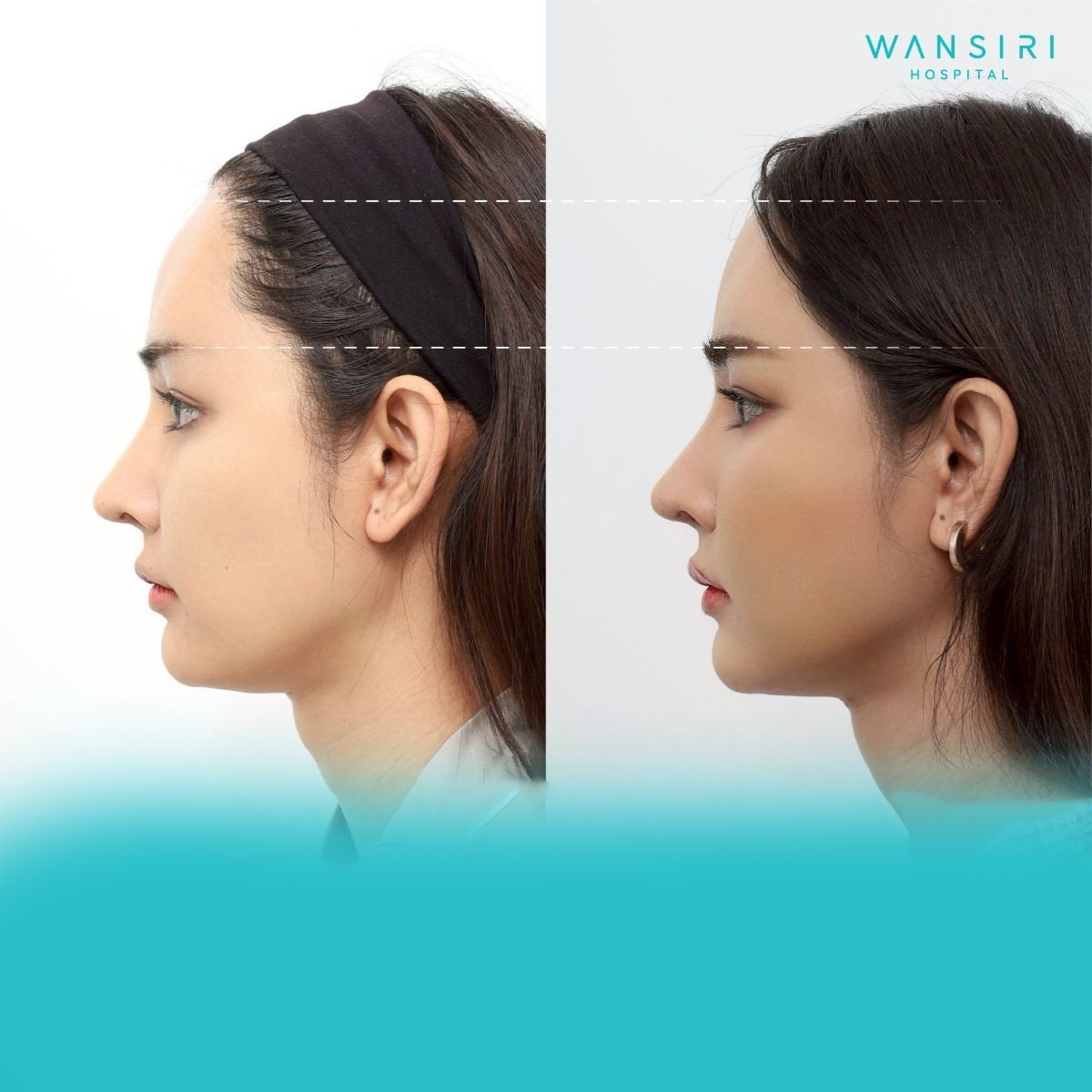 Antes y después de transferencia de grasa facial en Wansiri Hospital, mejor contorno facial
