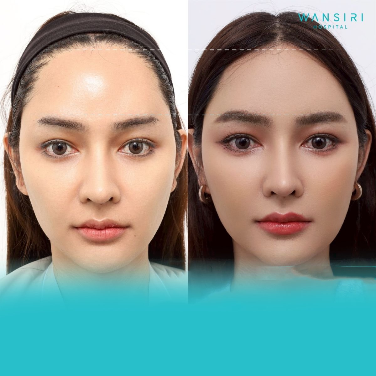 Antes y después de transferencia de grasa facial en Wansiri Hospital, volumen facial mejorado