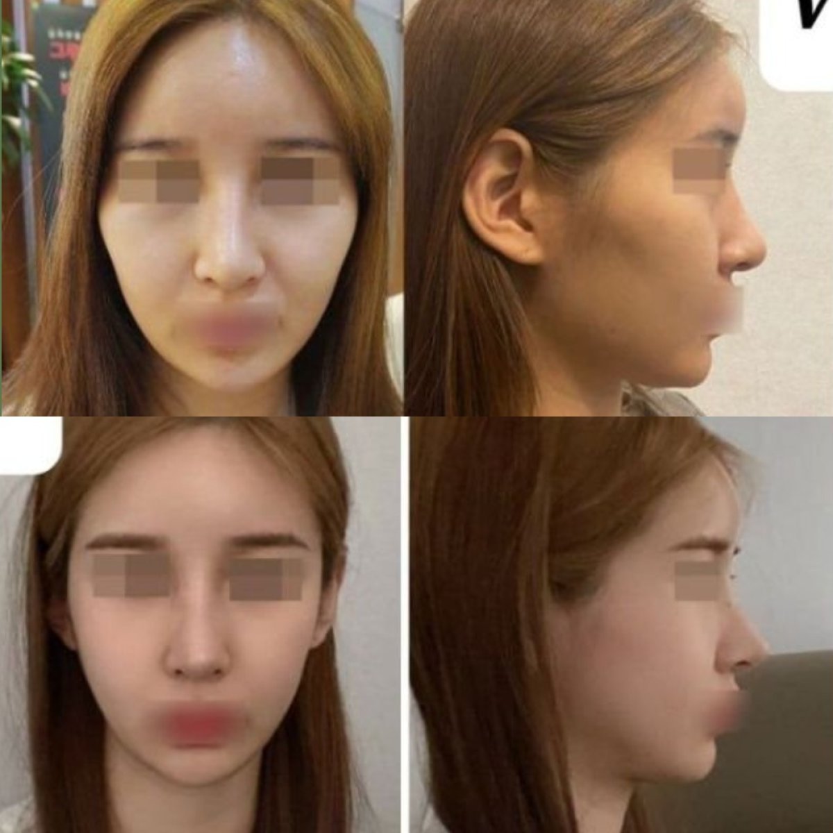 Resultados antes y después de cirugía de feminización facial en VG Plastic Surgery, rasgos suaves