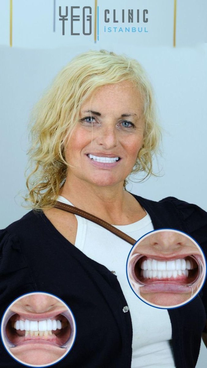 Full dentures installation before and after results at YEG Clinic, improved smile aesthetics