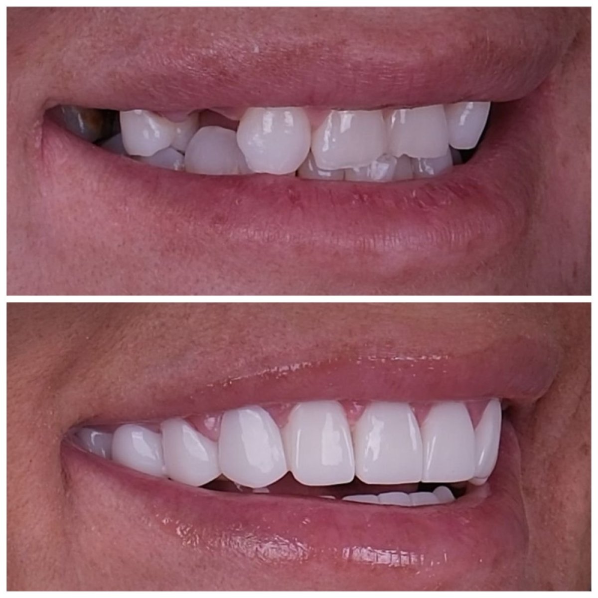 Результат до та після встановлення Emax вінірів у Lara Smile Dental Clinic – покращення усмішки