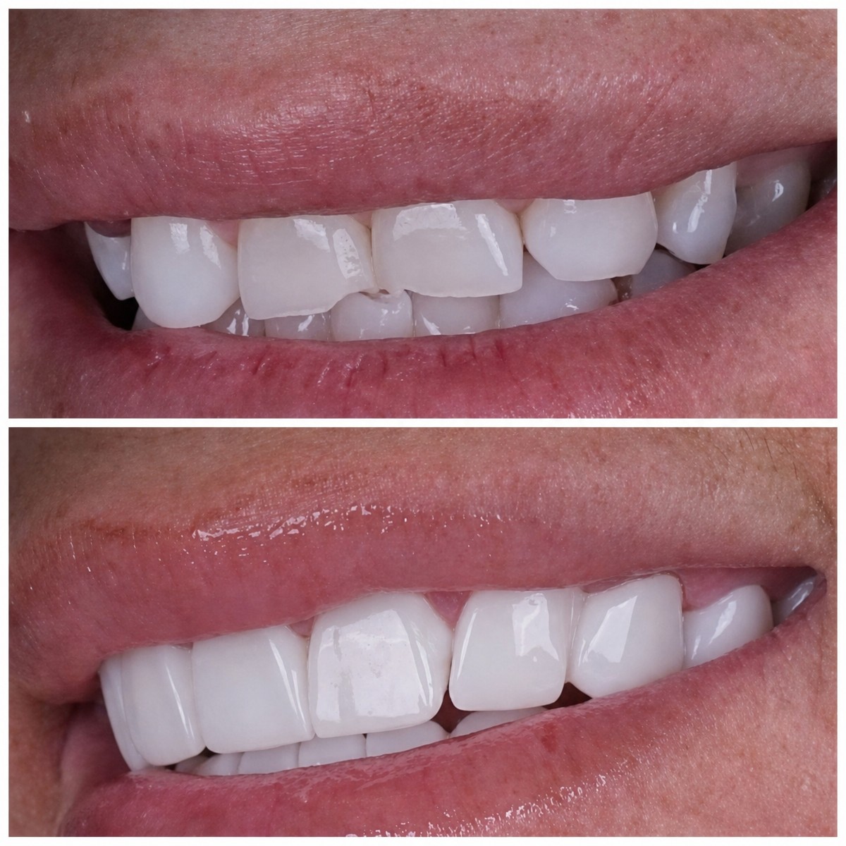 Before and after Emax veneers result at Lara Smile Dental Clinic, improved smile aesthetics