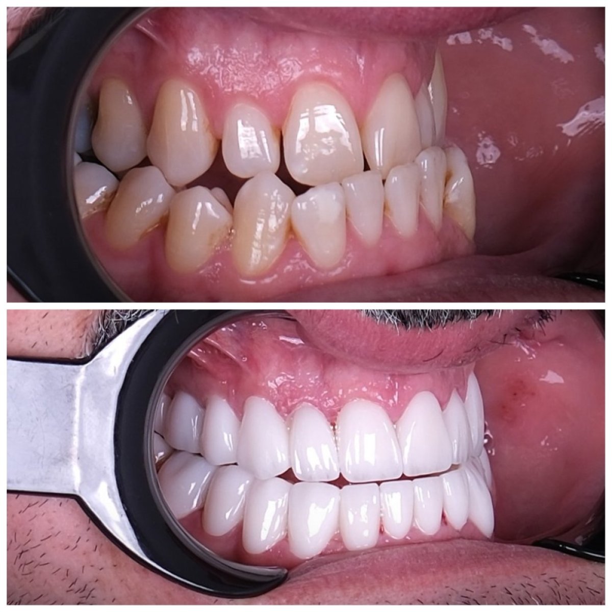 Resultados antes y después de Hollywood Smile en Lara Smile Dental Clinic – transformación con carillas