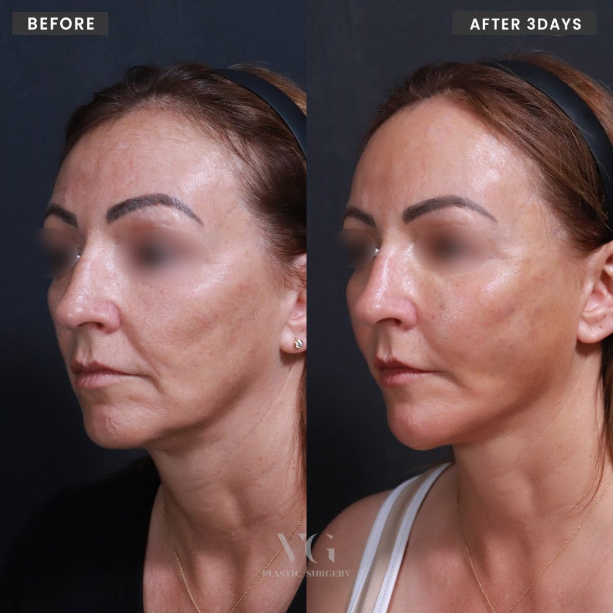 До и после нитевого лифтинга в VG Plastic Surgery, видимый результат подтяжки лица