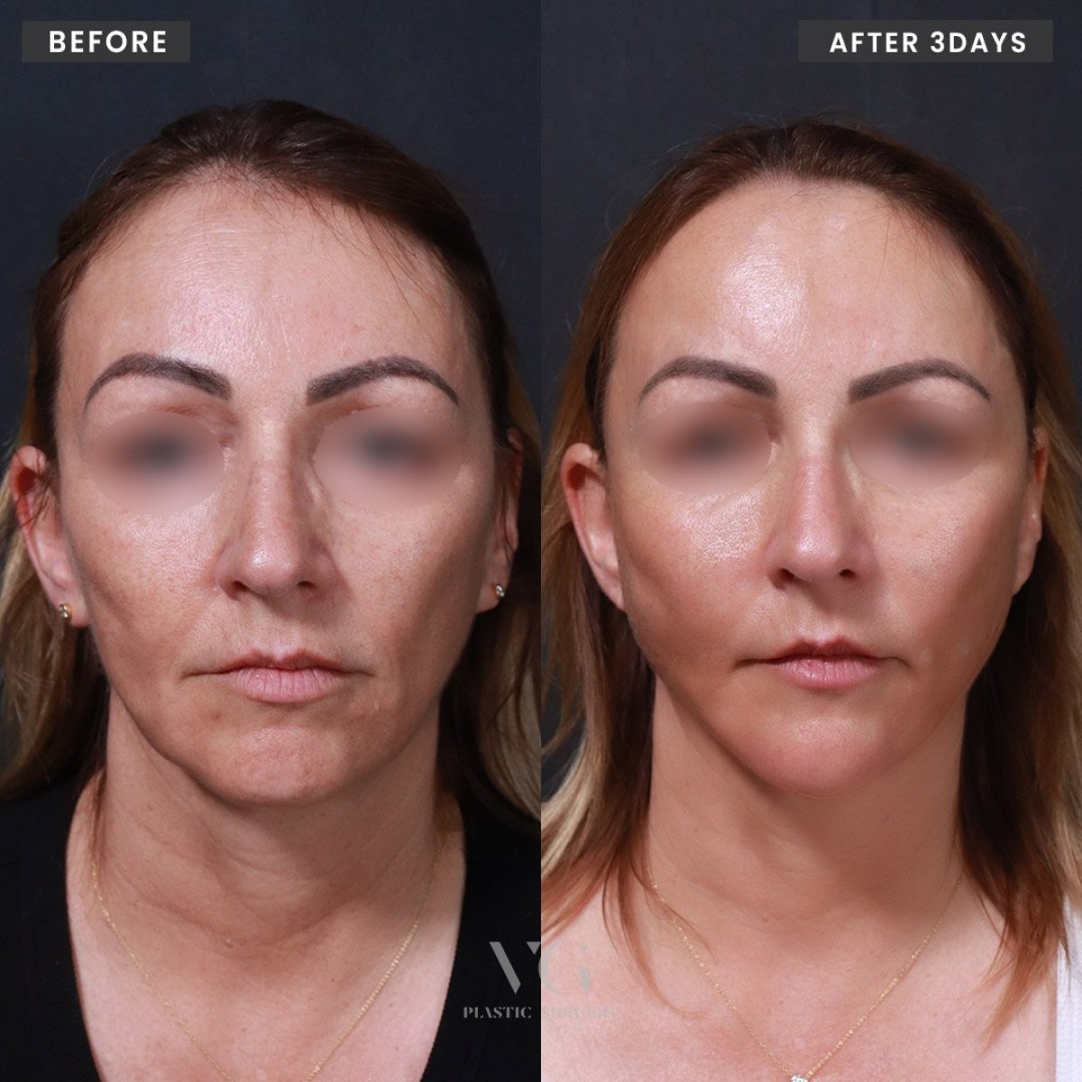 نتائج شد الوجه بالخيوط قبل وبعد في VG Plastic Surgery، تجديد شباب الوجه خلال 3 أيام