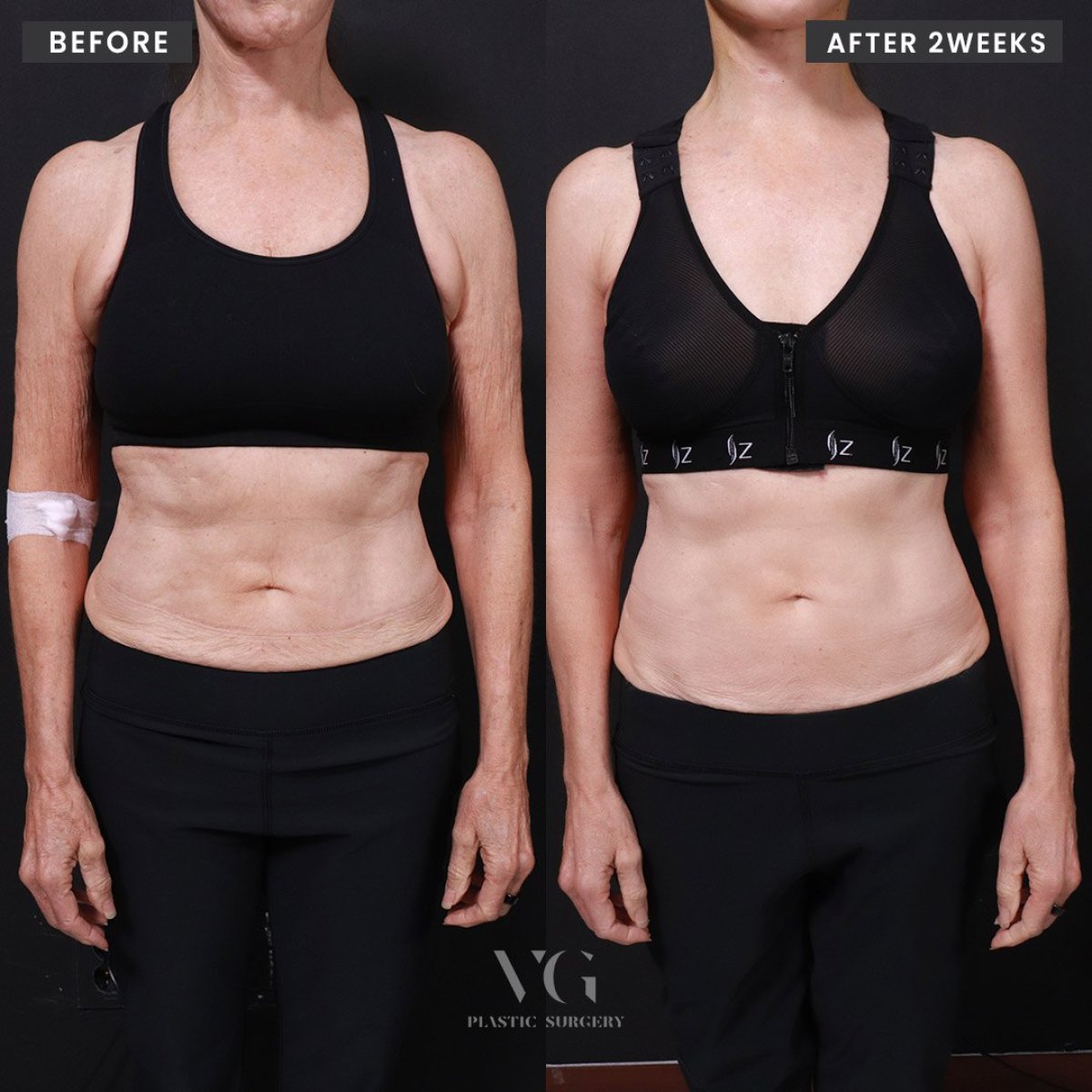 Before and after arm lift (brachioplasty) results at VG Plastic Surgery, improved arm contour