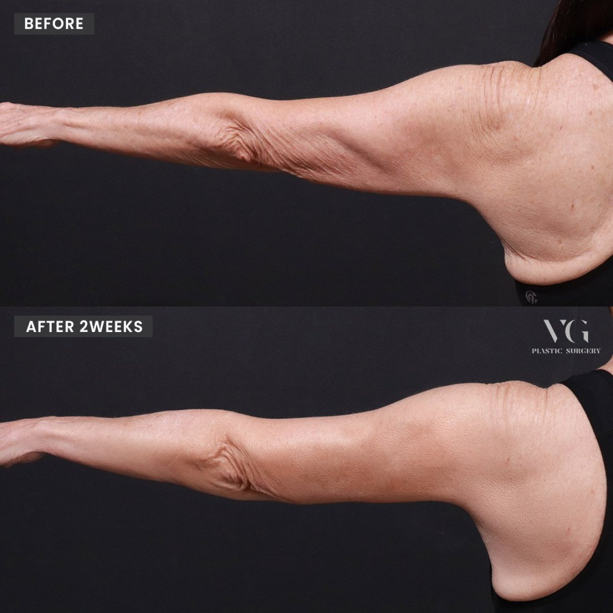 Before and after arm lift results at VG Plastic Surgery – improved arm contour after brachioplasty