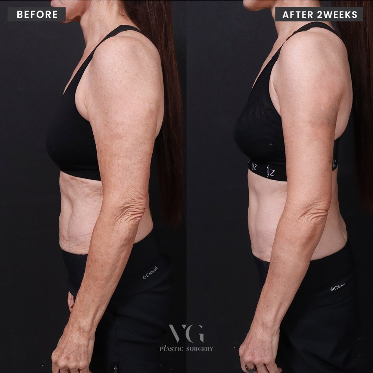 Before and after arm lift (brachioplasty) results at VG Plastic Surgery, improved arm contour