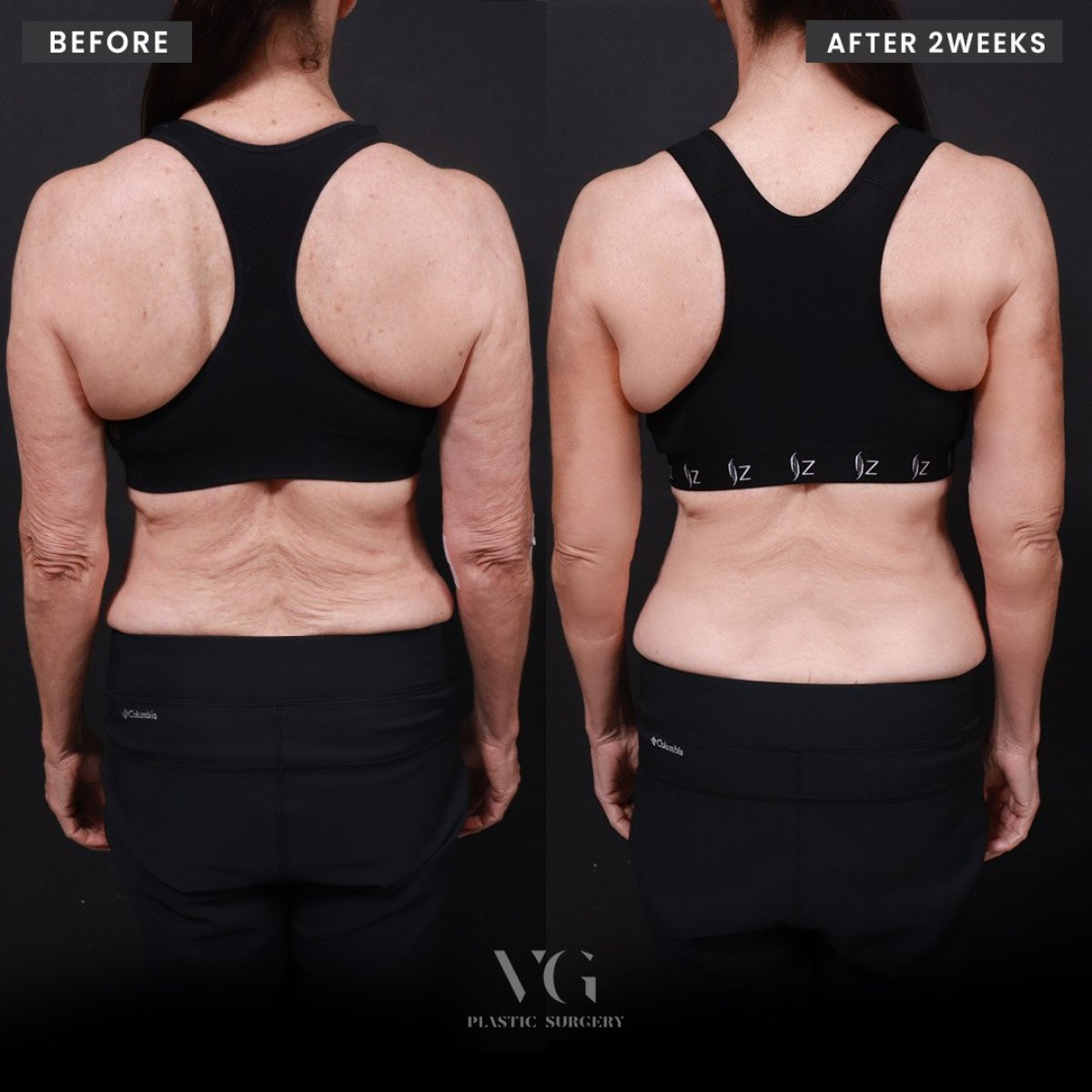 Результаты до и после брахиопластики в VG Plastic Surgery, улучшенный контур рук