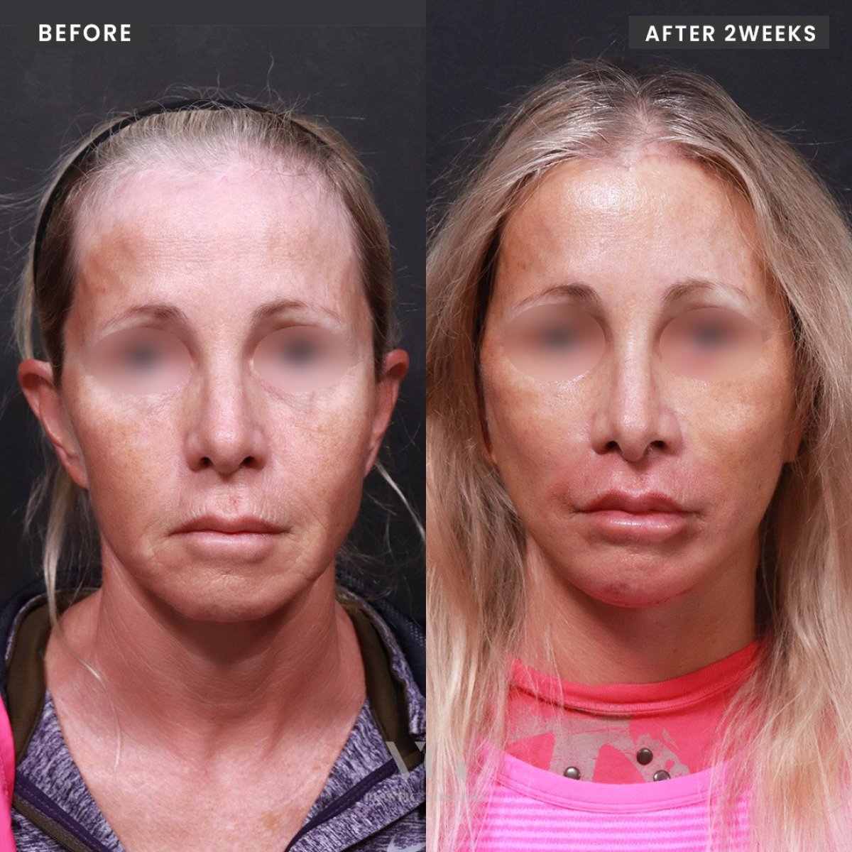 Resultados de lifting facial antes y después en VG Plastic Surgery, rejuvenecimiento facial tras 2 semanas