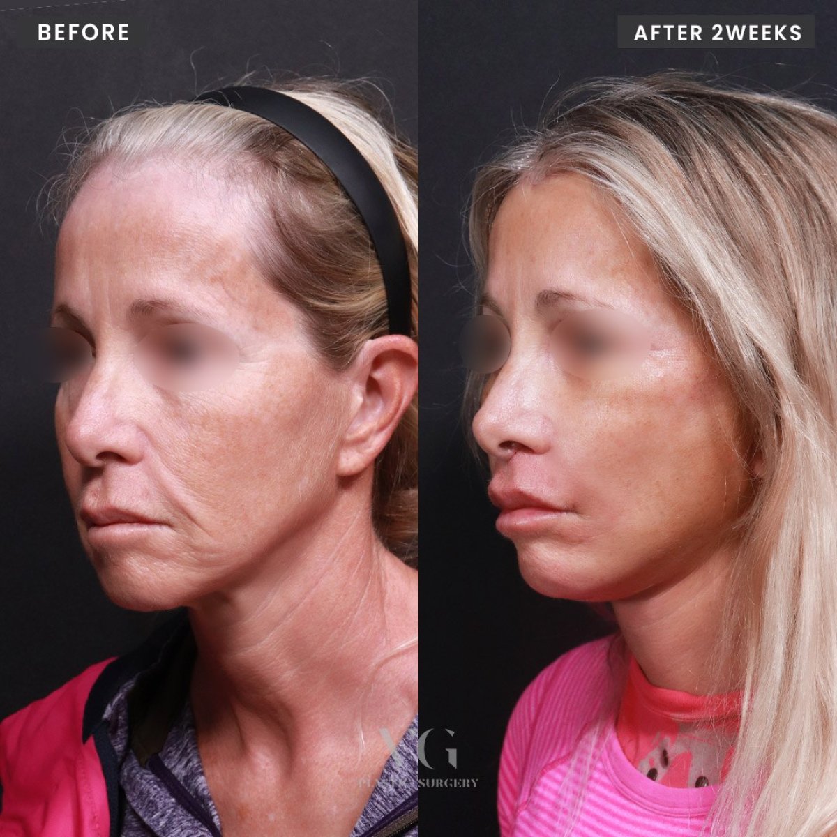 Результаты подтяжки лица до и после в VG Plastic Surgery, омоложение через 2 недели