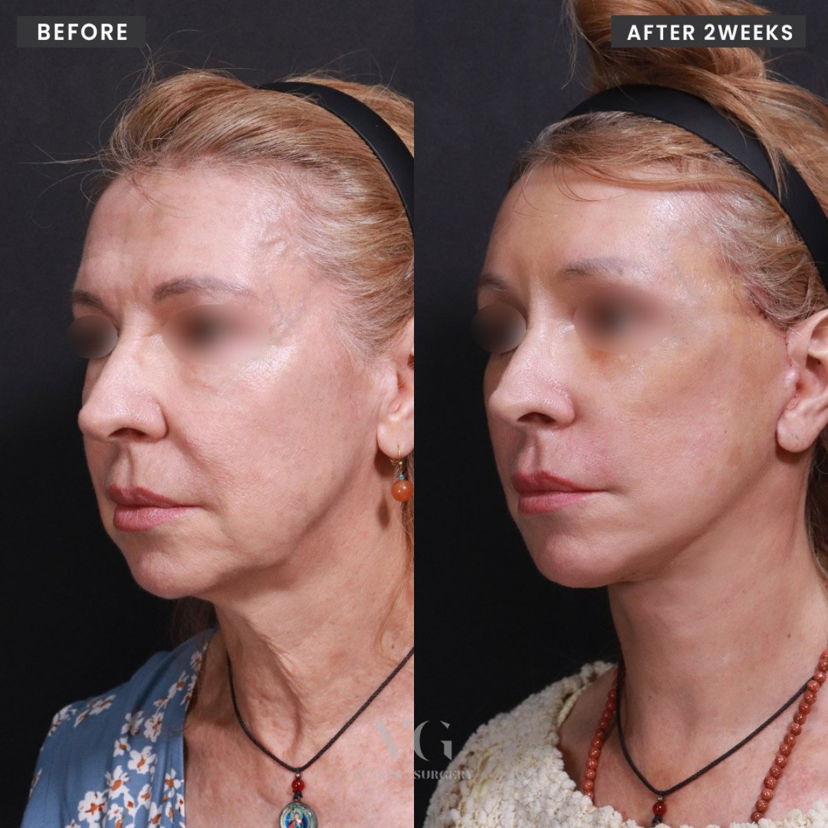 Facelift before and after results at VG Plastic Surgery, visible facial rejuvenation after 2 weeks
