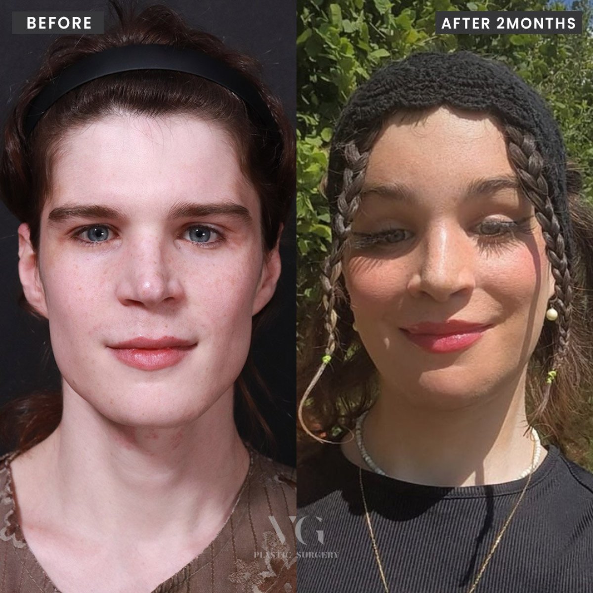 Resultados de cirugía de feminización facial antes y después en VG Plastic Surgery, 2 meses