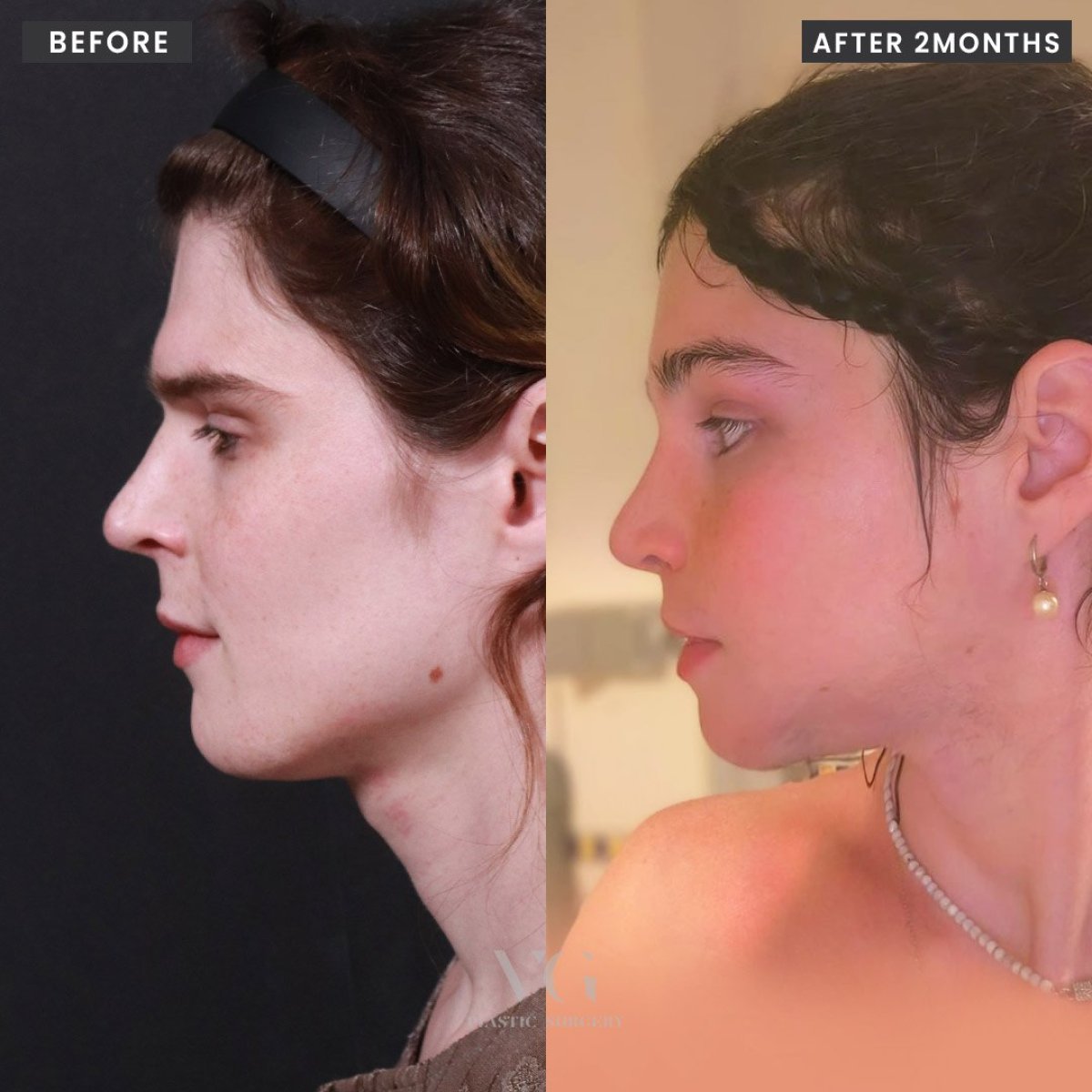 Resultados de cirugía de feminización facial en VG Plastic Surgery, 2 meses después