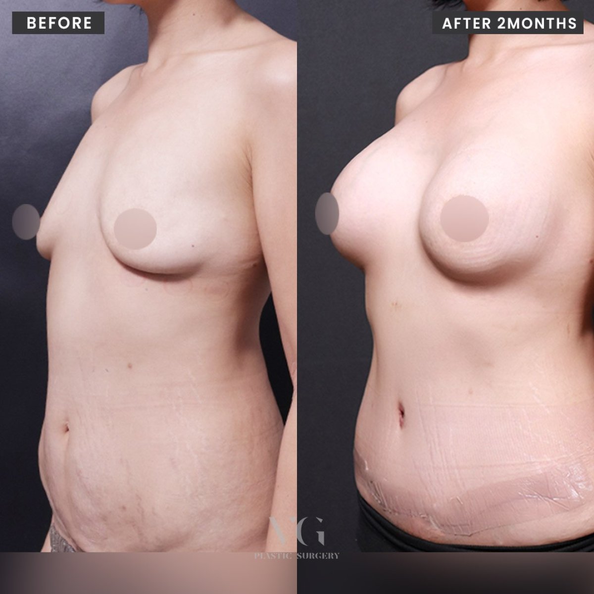 Resultados de mommy makeover antes y después en VG Plastic Surgery – mejora de pecho y abdomen
