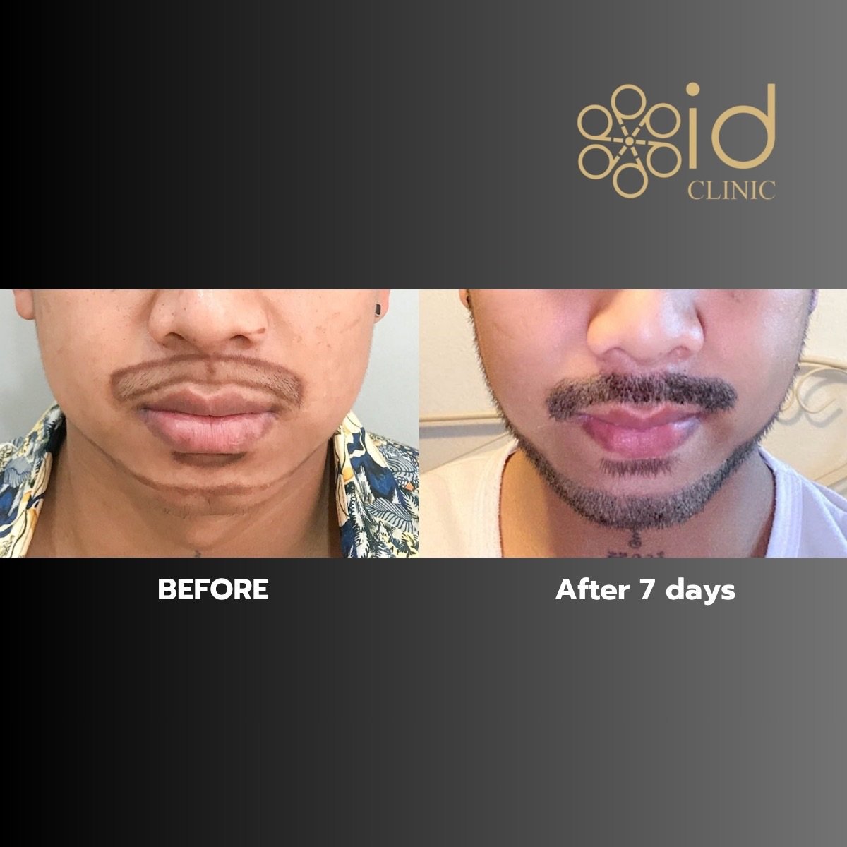 Résultats greffe de barbe à ID Clinic Bangkok, barbe plus dense après 7 jours