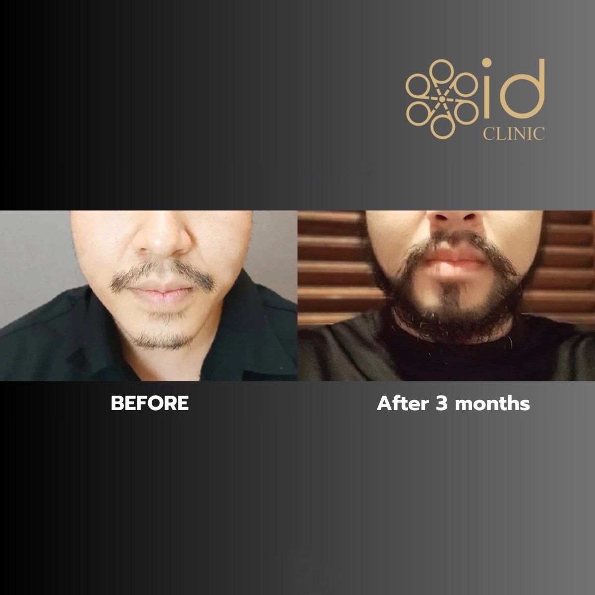 Résultats de greffe de barbe à ID Clinic Bangkok, barbe plus dense après 3 mois
