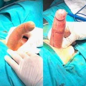 Penile Implant Surgery (Rigicon Infla10 AX Expansion Technology) – Standard Programme - photo 4