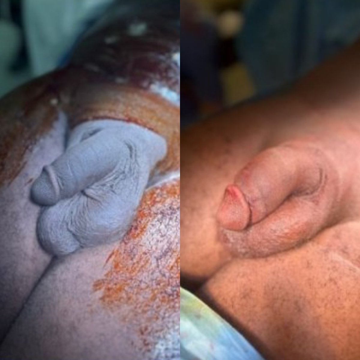 Resultados antes y después de aumento de pene en Uroaesthetic, mejora visible del tamaño