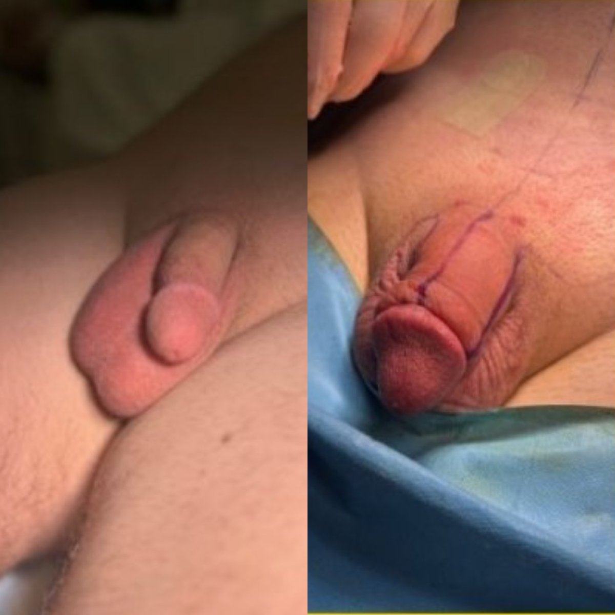 Resultados antes y después de aumento de pene en Uroaesthetic, mejora visible del tamaño