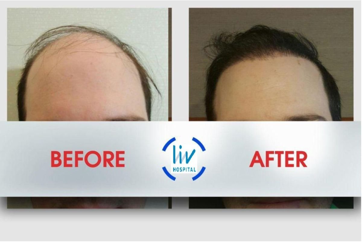 Before and after hair transplant results at Liv Hospital Ulus, improved hairline and density